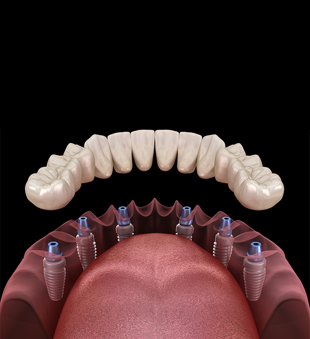 full mouth dental implants near me