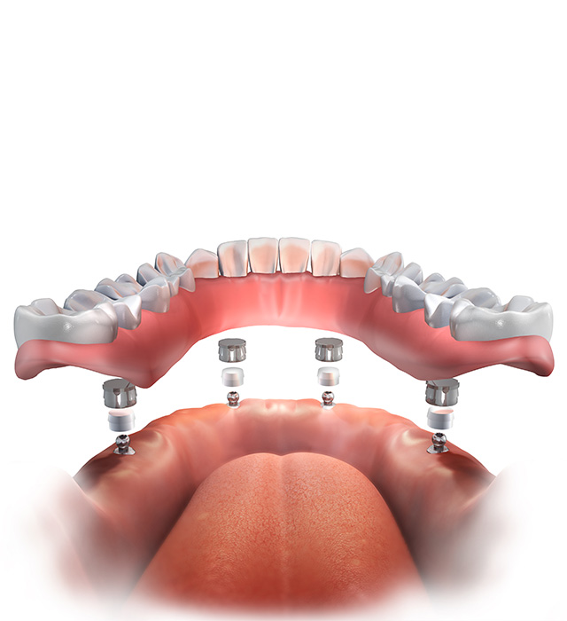 all on 4 implants