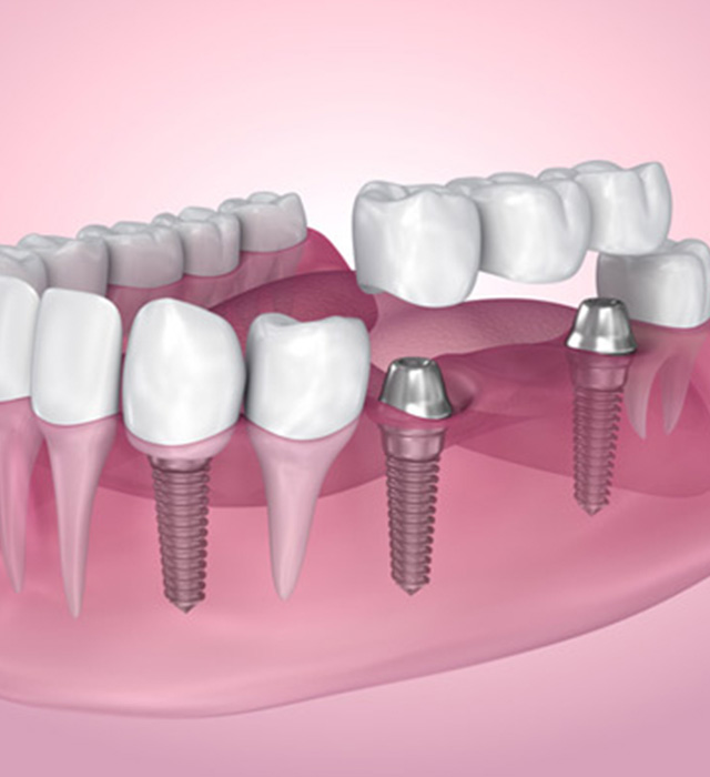 dentist that do implants near me