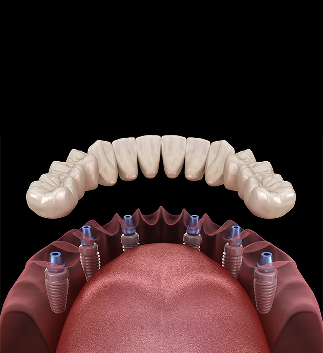 permanent dentures