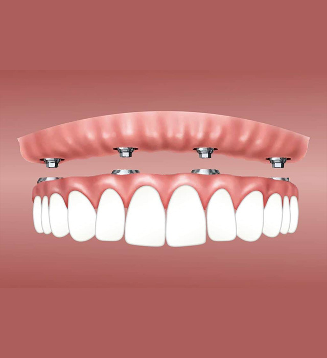 magnetic dentures